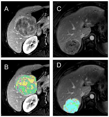 Leveraging radiomics and AI for precision diagnosis and prognostication of liver malignancies